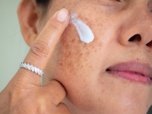 How to Get Rid of Hyperpigmentation